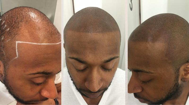 Microblading Micropigmentation hairline